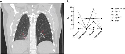 Case report: Invasive fungal infection in a patient with a rare CVID-causing gene (TNFRSF13B) mutation undergoing AML treatment